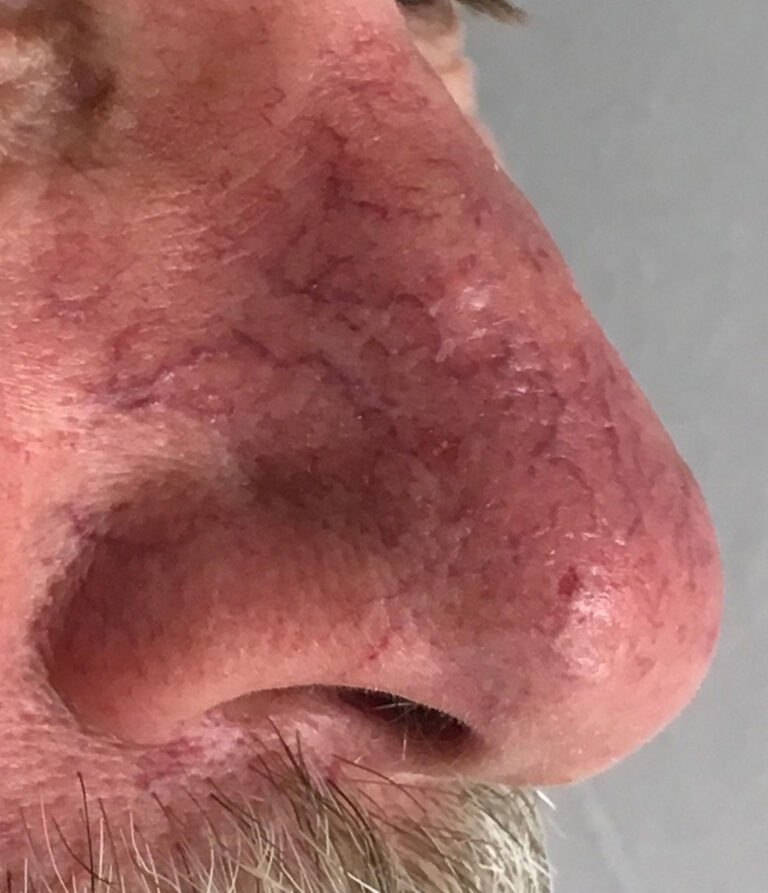 Photorejuvenation Halcyon Dermatology